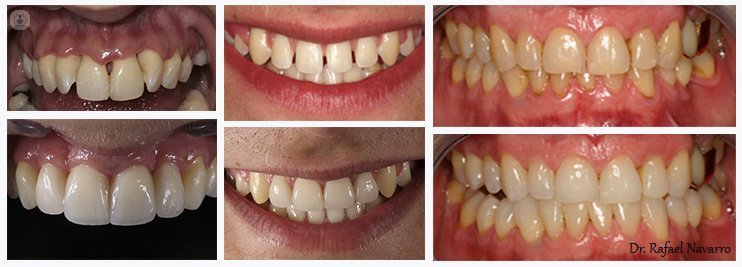 El blanqueamiento dental es una de las técnicas más conservadoras en odontología estética para cambiar el color de los dientes.