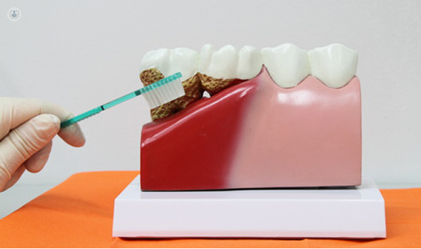 La periodontitis es una enfermedad que cursa con encías que sangran, engrosadas o rojizas, así como dientes móviles o halitosis.