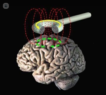 La estimulación magnética transcraneal se basa en la inducción electromagnética para activar las neuronas corticales, estimulando el córtex cerebral