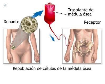 El trasplante de médula es el tratamiento por el que se destruye la médula del paciente y se reemplaza por precursores hematopoyéticos nuevos. 