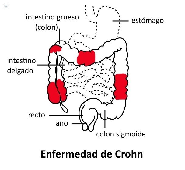 La enfermedad de Crohn es una patología inflamatoria intestinal que puede causar úlceras.