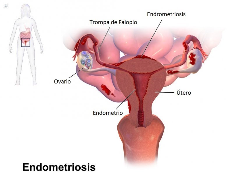 La endometriosis es una enfermedad causada por la migración de células del endometrio a otros órganos, como ovarios o peritoneo pélvico