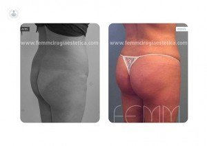 lipotransference buttocks fat