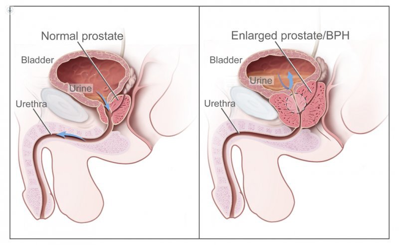Cancer prostata benigno