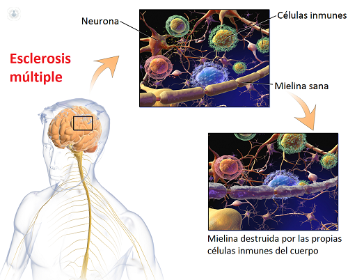 La esclerosis múltiple es una enfermedad que afecta a personas jóvenes