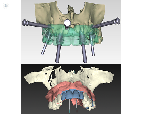 La implantología guiada por ordenador permite la correcta posición de implantes