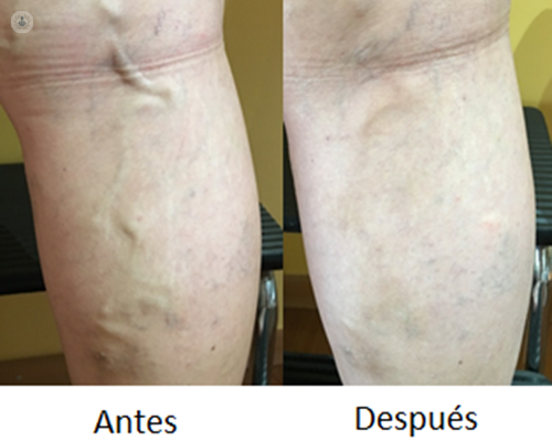 Es una pierna antes y después de un tratamiento para las varices