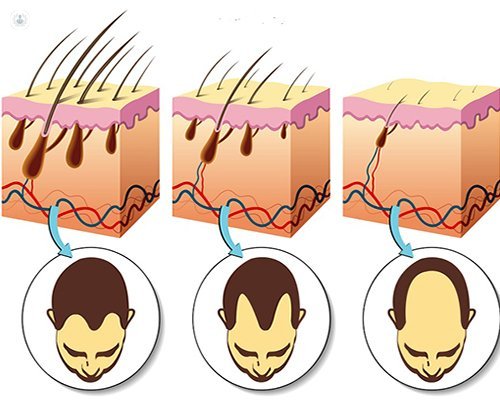 fibra vacío Coche Alopecia, características y tratamientos