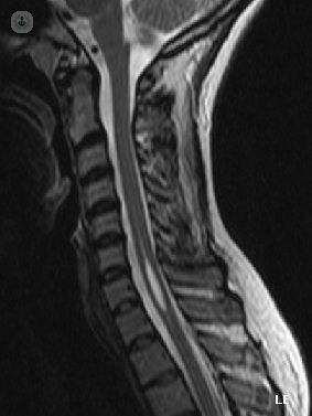 siringomielia enfermedad medula espinal