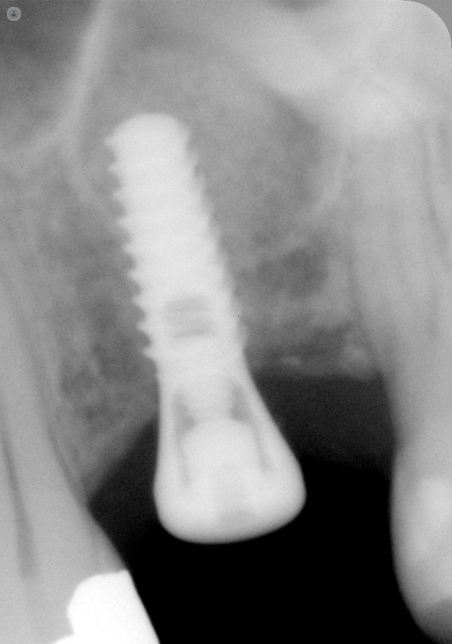 radiografia implant