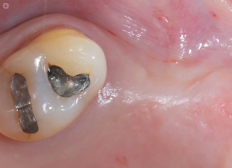 prior implant