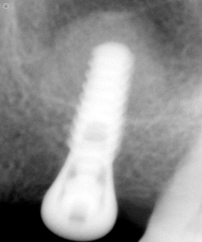 graft and implant