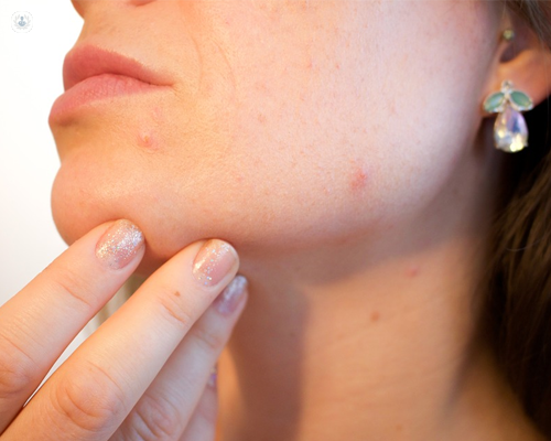 El 80-90% de población sufre acné a lo largo de su vida - Top Doctors