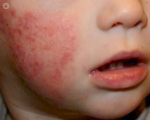 Dermatitis atópica en niños: cómo | dermatólogo -