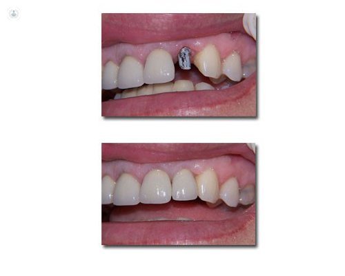 Зубной имплантат до и после того, как