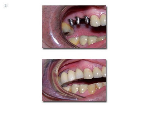 resultados implantes dentales
