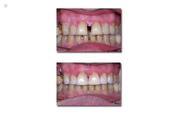 diastema teeth