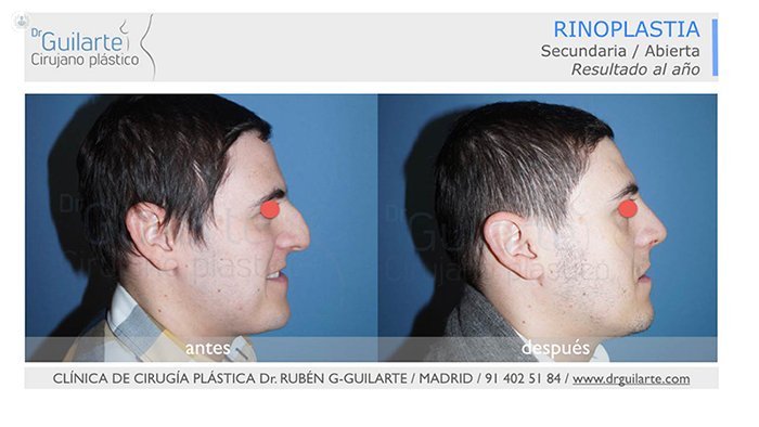 rhinoplasty results