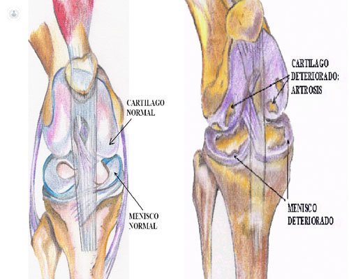Promesa Maniobra Soportar Artrosis de rodilla: síntomas y tratamiento