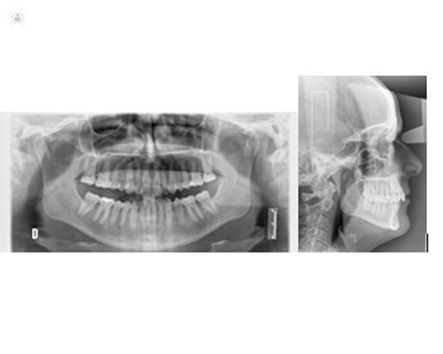 radiografia_dientes