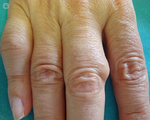 Siempre Descompostura juicio Artritis reumatoide: síntomas, causas, diagnóstico y tratamiento