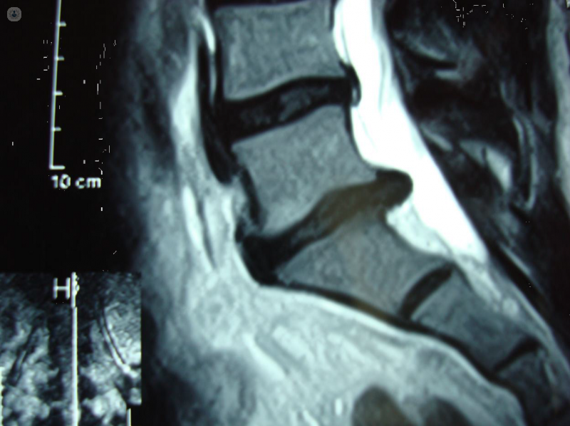 Pruebas complementarias para el diagnóstico de las enfermedades reumáticas: resonancia magnética de la columna lumbar, en la que se aprecia una hernia discal lumbar.