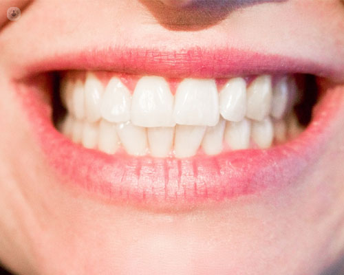 implantes dentales ventajas tratamientos