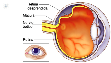 desprendimiento de retina