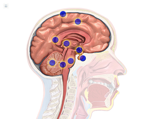 tumor cerebral