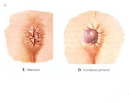 Hemorrhoid types