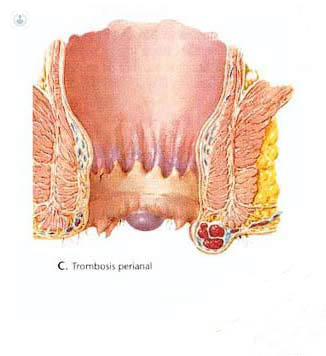 Perianal thrombosis
