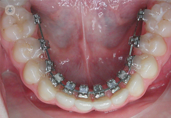 poto paciente con ortodoncia lingual