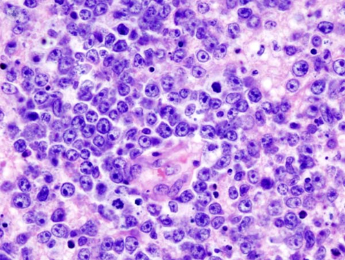 linfocitos celulas linfoma