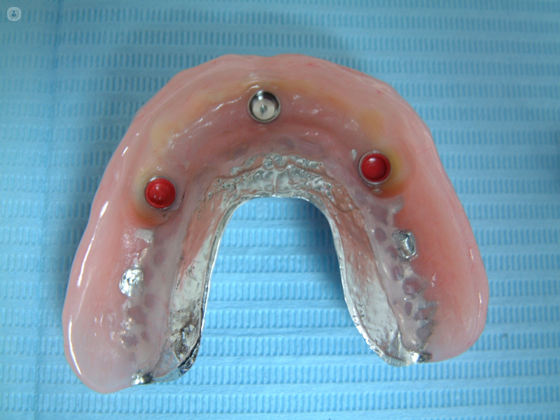 protesis dental fija
