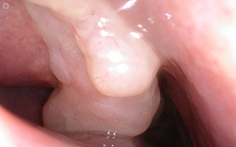 poliposis nasal