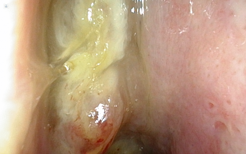 poliposis nasal infectada