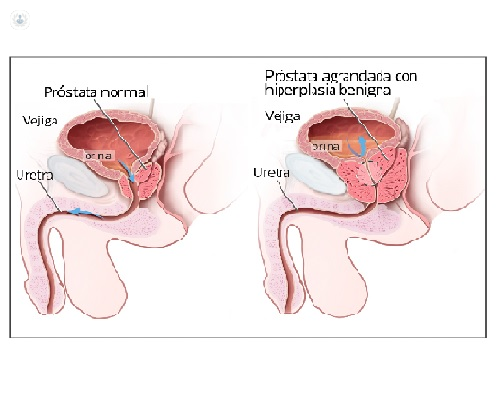 adenoma de prostata y psa
