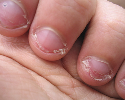 Por ley resumen Presidente Enfermedades de las uñas más comunes | Top Doctors