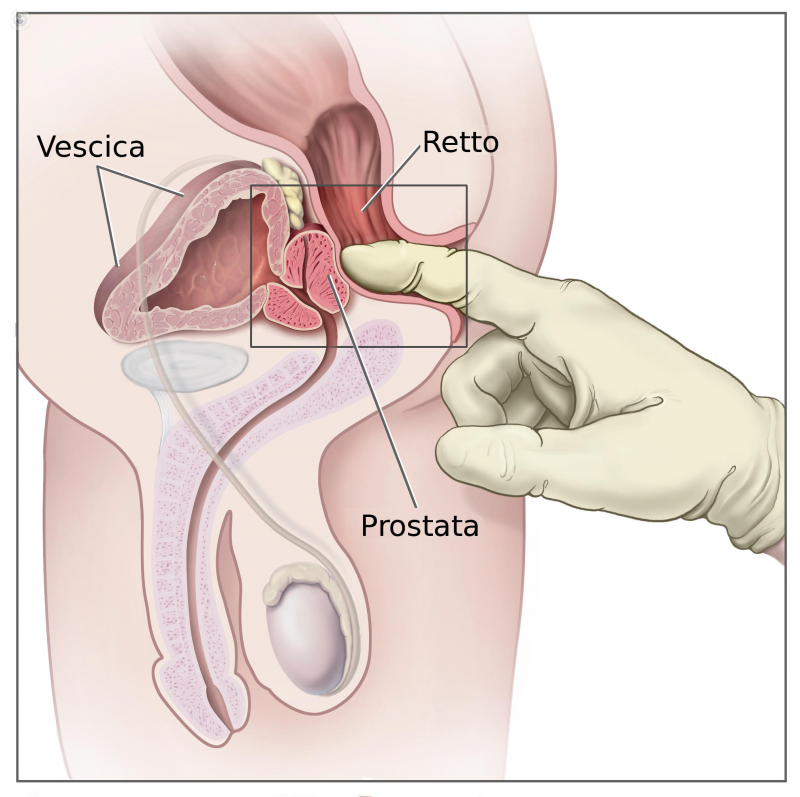 cancer de prostata diagnostico biopsia hipertrofia prostatica grado iv tratamiento