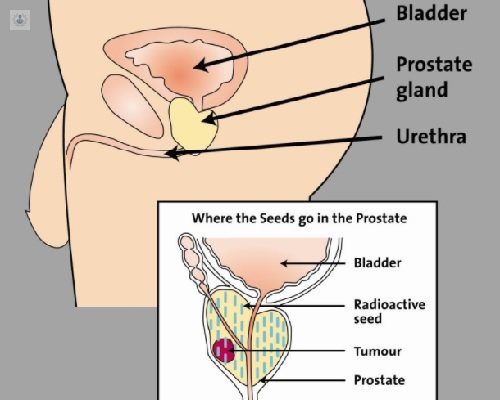 radioterapia prostata opiniones