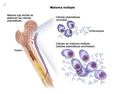 Impedir Silenciosamente carga Mieloma múltiple: qué es, síntomas y tratamiento | Top Doctors
