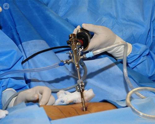 discectomía discal lumbar endoscópica by Topdoctors
