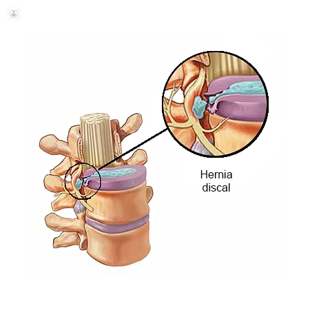 Afilar aguacero federación Cirugía percutánea hernia discal: qué es, síntomas y tratamiento | Top  Doctors