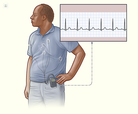 Holter de presión arterial - Top Doctors