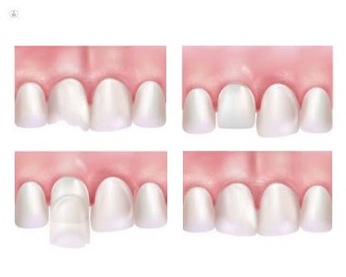 Diferencias entre carillas dentales de porcelana y de composite