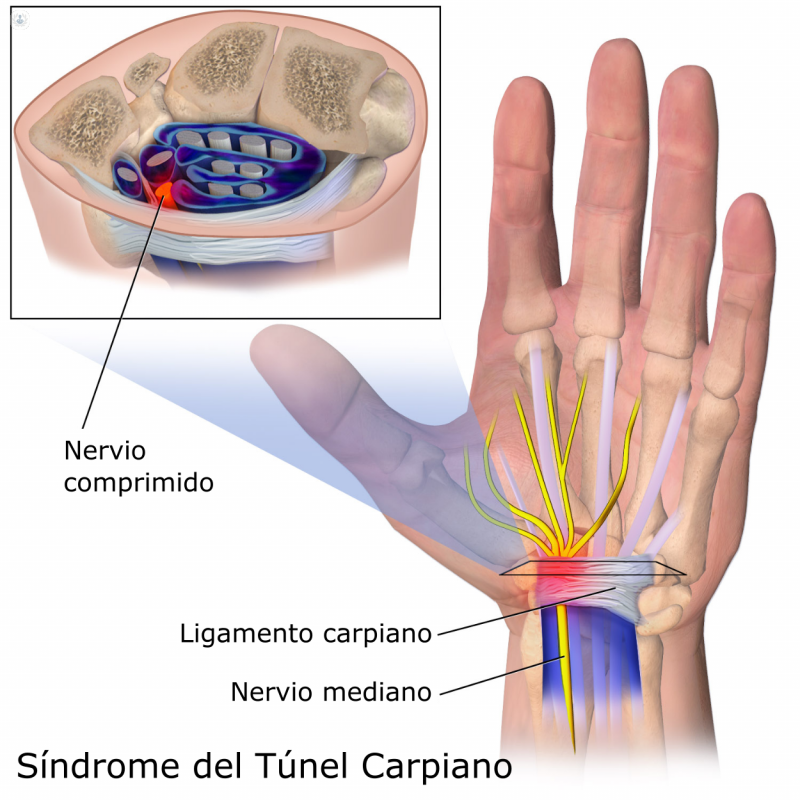 Cirugía túnel carpiano: qué es, síntomas y tratamiento