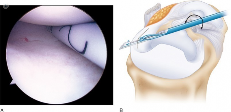 La aguja Fas T-Fix se inserta y cruza la unión menisco-capsular - Top Doctors