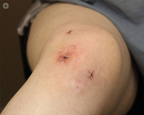 La artroscopia de rodilla permite abordar las lesiones de rodilla con mínima invasión - Top Doctors