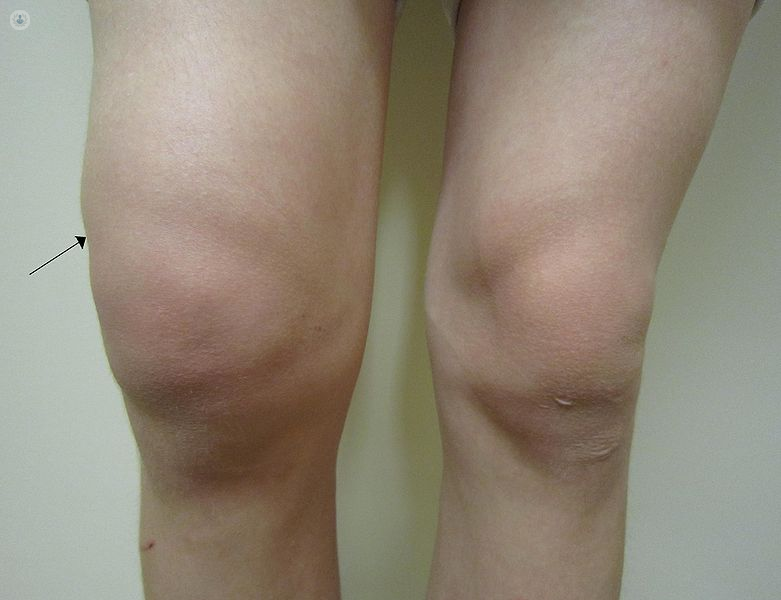 escocés Alargar estático Artrosis de rodilla: qué es, síntomas y tratamiento | Top Doctors