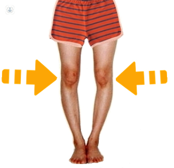 Limitado carga Presentar Corrección genu varo (piernas arqueadas): qué es, síntomas y tratamiento |  Top Doctors